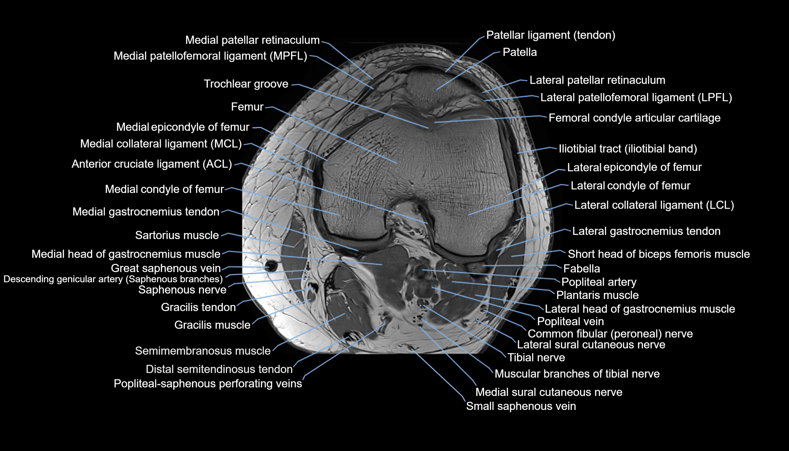 MRI knee  axial cross sectional anatomy 3T radiology  image-img-00001-00020.webp